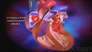 Врожденные пороки сердца у детей