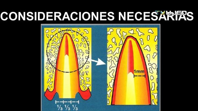 ENDOPOSTES METÁLICOS VACIADOS O COLADOS (POSTES DE ENDODONCIA) смотреть онлайн