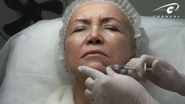 Коррекция подбородочной складки смотреть онлайн