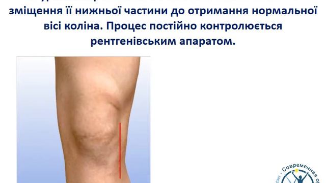 Остеотомія