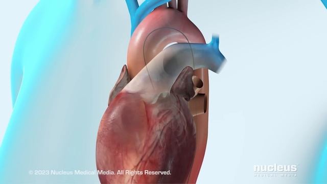 Transcatheter Aortic Valve Implantation (TAVI) смотреть онлайн