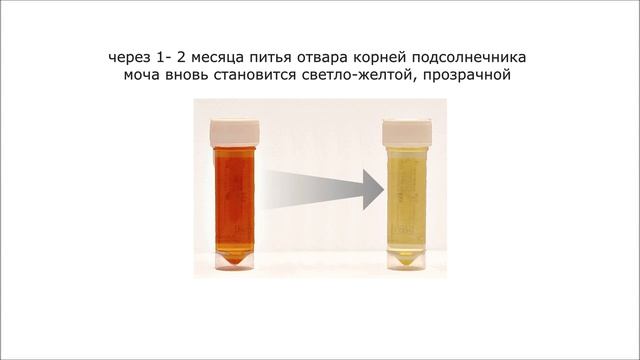 Артрит, артроз, остеохондроз, радикулит, подагра - выводим соли и болезнь уходит. смотреть онлайн