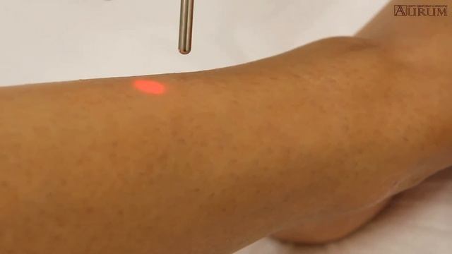 Лазерная эпиляция ног