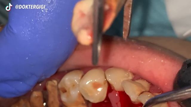 UNBELIEVABLY GIGANTIC TARTAR | KARANG GIGI | Dentist | Dokter Gigi Tri Putra смотреть онлайн