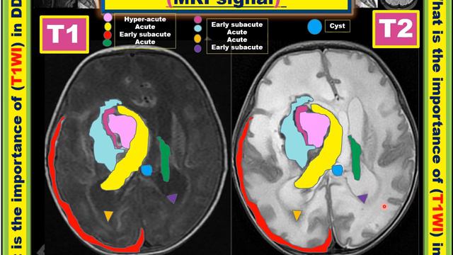 MRI Learning (7) T1WI (part 3); Blood MRI signal смотреть онлайн