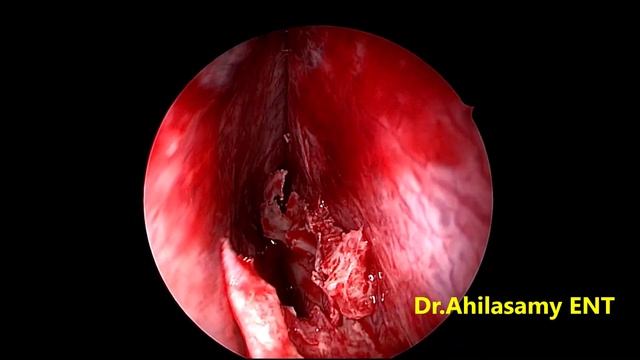 (R) Ethmo Chaonal Polyp with (B) CRSwNP -FESS under LA смотреть онлайн