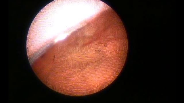 Goniosynechialysis Using Ophthalmic Endoscope By Masahiro Maeda