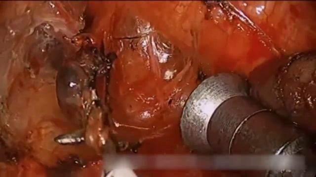 Asvide: Using CC Liu’s maneuver for left 7th lymph node dissection смотреть онлайн