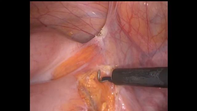Laparoscopic sigmoid resection. Лапароскопическая резекция сигмовидной кишки смотреть онлайн