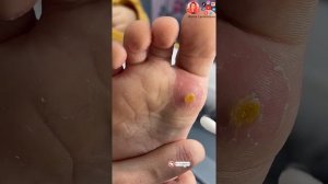 Прижигание бородавки азотом / Бородавка на стопе