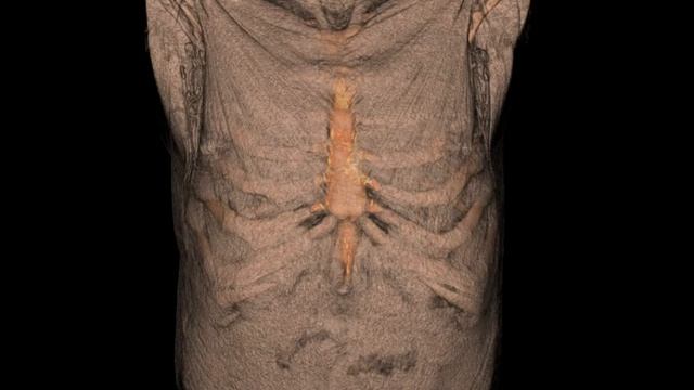 Axillary lymph nodes and vessels Reconstruction смотреть онлайн