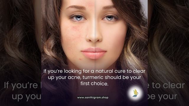 Acne? No problem! Turmeric is a powerful ingredient that helps in clearing up acne and pimples. смотреть онлайн