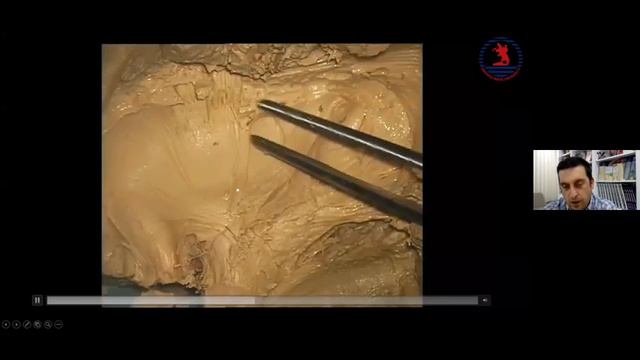 Lateral to Medial Dissection of Central Core : Cadaveric Dissections - Serhat Baydın ,M.D. смотреть онлайн