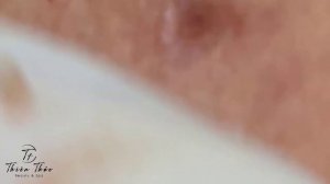 Pimple popping - Squeeze Acne pustules with Sac Dep Thien Thao Spa #006