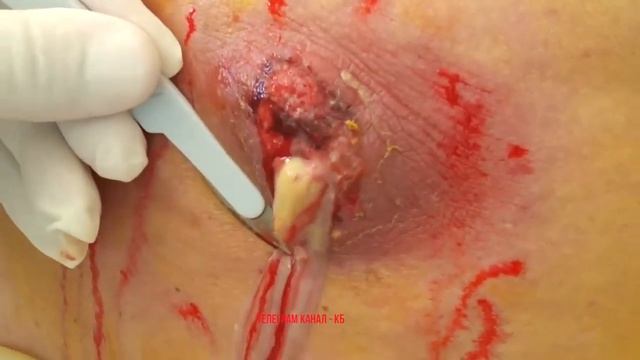 Удаление огромного гнойного прыща смотреть онлайн