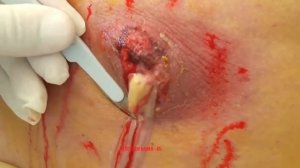 Удаление огромного гнойного прыща