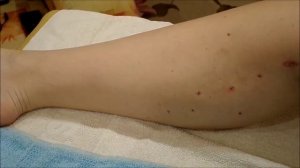 Прошел месяц после операции  Удаление вен.Флебэктомия