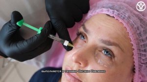 Носослёзная борозда: коррекция филлером