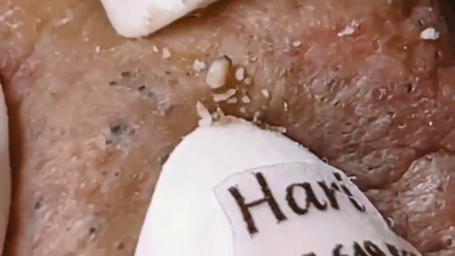 ✅ Выдавливание прыщей #25 смотреть онлайн