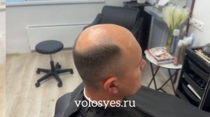 До и после, замещения волос!