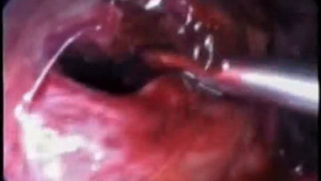 Гематома пузырно-маточной клетчатки после кесарева сечения. смотреть онлайн