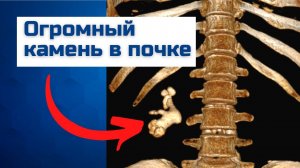Удаление большого коралловидного камня почки