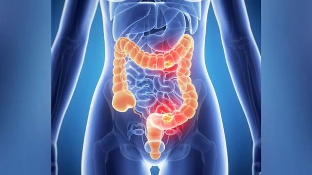 Какие причины воспаления кишечника и куда отдаёт боль в кишечннике ?