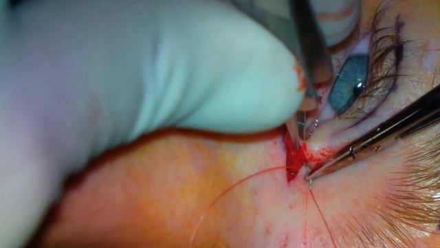 Skin re-draping w/ canthal tendon plication for blepharophimosis, ptosis, epicanthus inversus BPES смотреть онлайн