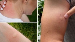 Лечение комариных укусов / Treatment of mosquito bites