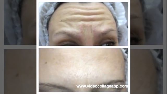 Видео в динамике до и после инъекций лба и межбровья ботулотоксином Ксемин