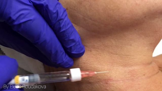 Restylane Skinboosters - Neck (by Elena Roudakova at Wellness Centre 4 You) смотреть онлайн