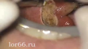 Коблаторная тонзиллэктомия