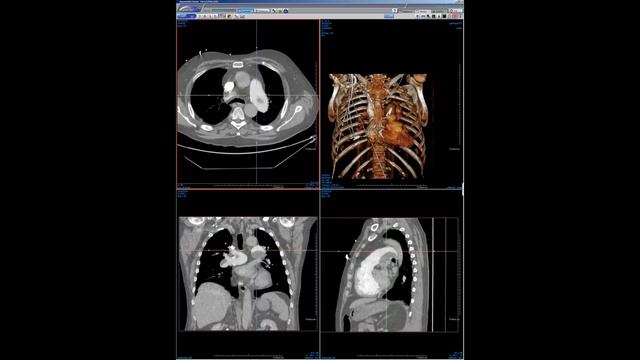 STR Cardiothoracic Case Webinar 4/9/2020 смотреть онлайн