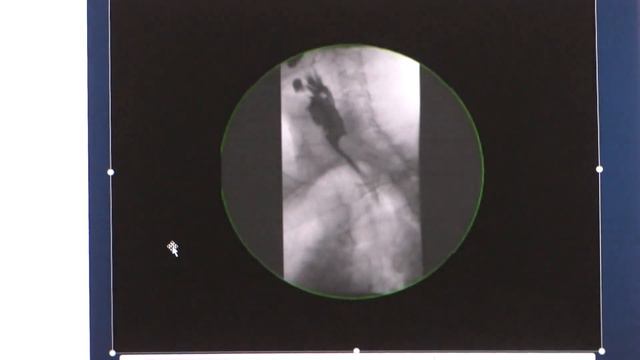 27 Michel Kahaleh Эндоскопия в «третьем пространстве» смотреть онлайн