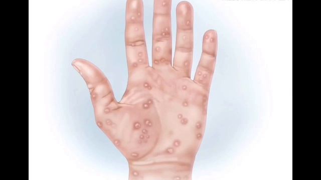 СИФИЛИС ВА УНИ ДАВОЛАШ ЧОРАЛАРИ смотреть онлайн