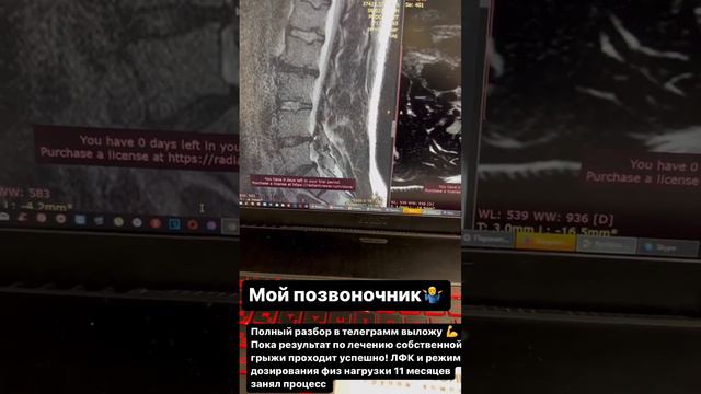 Мой позвоночник. Результаты МРТ диагностики. смотреть онлайн