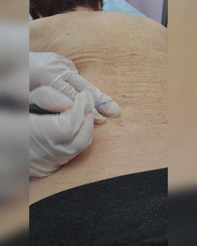 Удаление кератом и гемангиом радиоволновым методом (Сургитрон).mp4