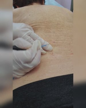 Удаление кератом и гемангиом радиоволновым методом (Сургитрон).mp4