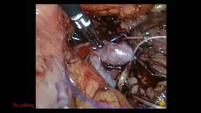 Renal vein injury repair during partial nephrectomy /ранение почечной вены/резекция почки смотреть онлайн