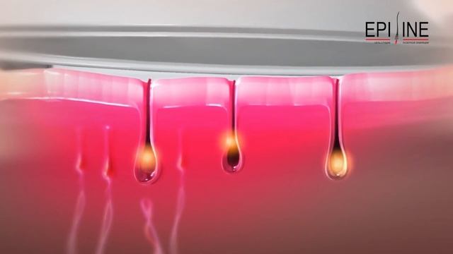 Лазерная эпиляция смотреть онлайн