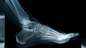 Как выглядит пяточная шпора: фото шпоры на ногах, пятке, симптомы на ступне, некротический фасциит