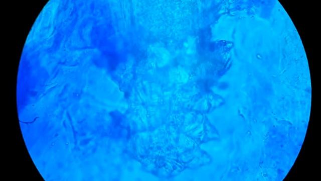 Кожный клещ Demodex на кусочке кожи губы. 630х смотреть онлайн