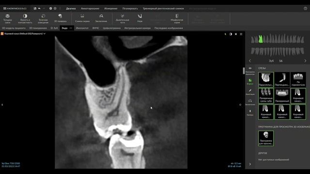 Обзор эндо-модуля в ПО DTX Studio Clinic смотреть онлайн