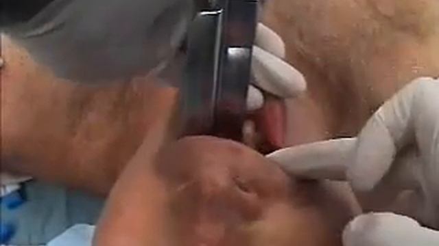 Интубация трахеи    Tracheal Intubation