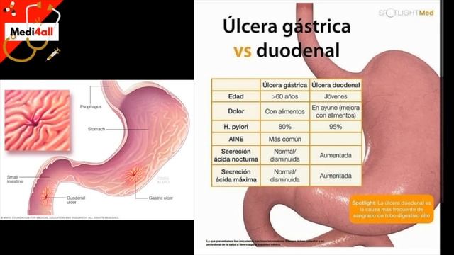 Como saber si tengo Helicobacter pylori? (Gastritis o Ulcera Estomago?) | Sintomas y Tratamiento смотреть онлайн