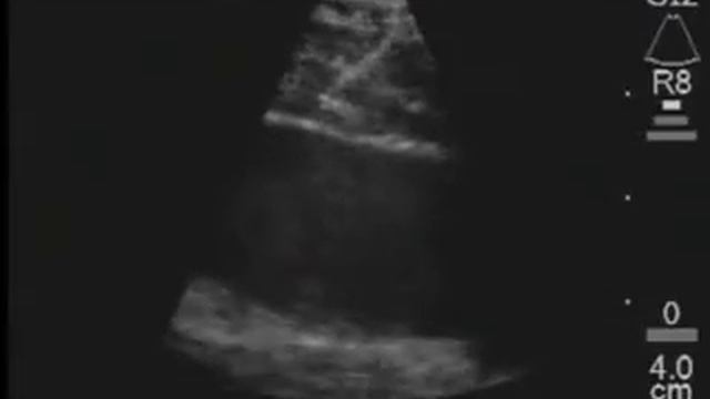 Endobronchial Ultrasound (EBUS) Biopsy of Mediastinal Lymph Nodes 2 смотреть онлайн