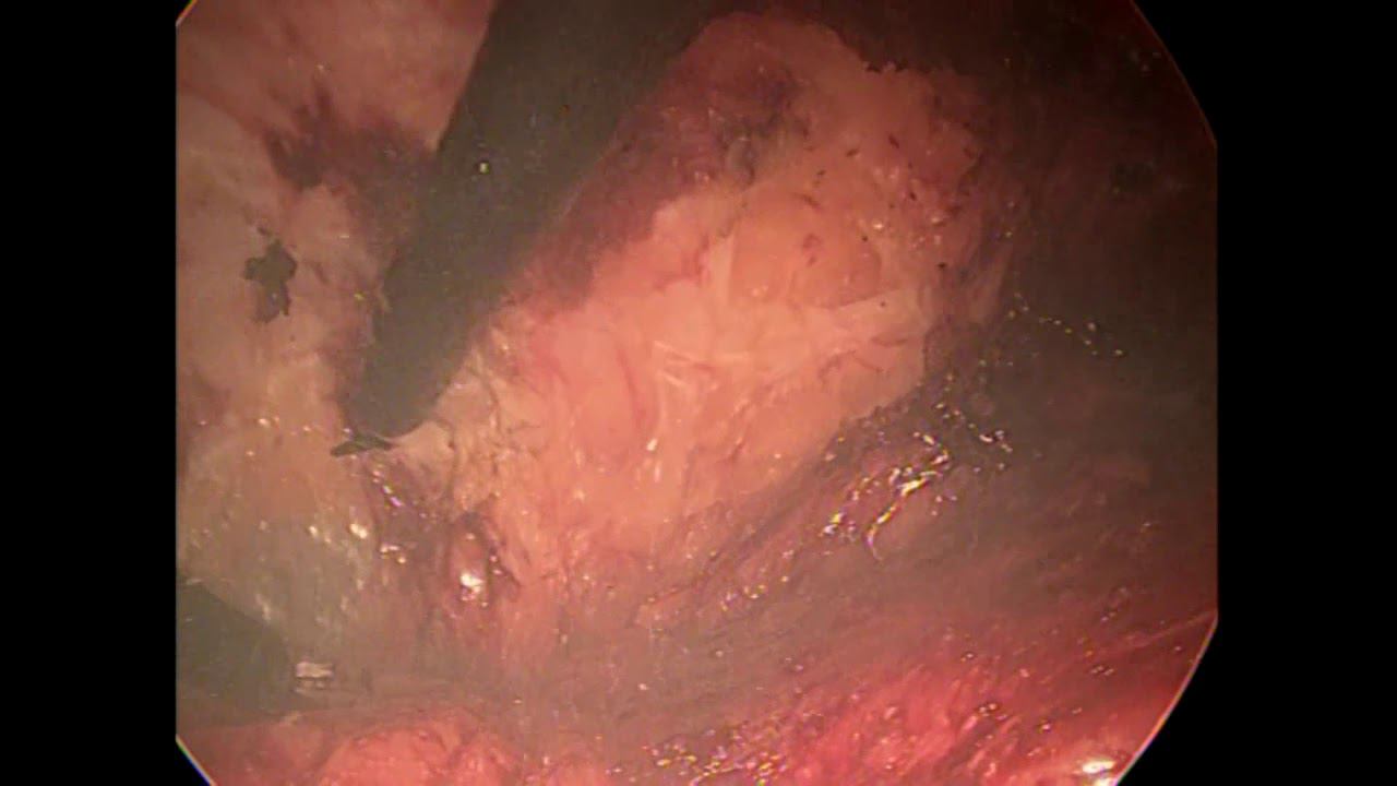 диастаз прямых мышц, Diastasis Recti,