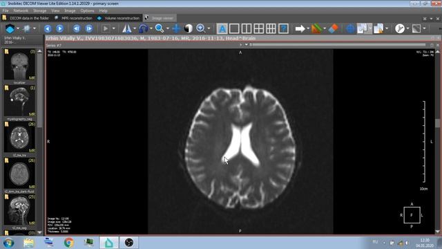 ИССЛЕДОВАНИЕ ГОЛОВЫ НА КОМПЬЮТЕРНОЙ ТОМОГРАММЕ И МАГНИТНО РЕЗОНАНСНОЙ ТОМОГРАММЕ снимках 2020 01 0 смотреть онлайн