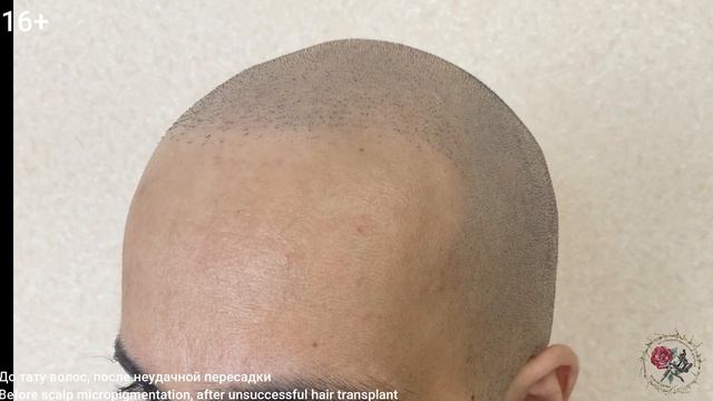 Трихопигментация близко, татуировка волос после неудачной пересадки. Scalp micropigmentation смотреть онлайн