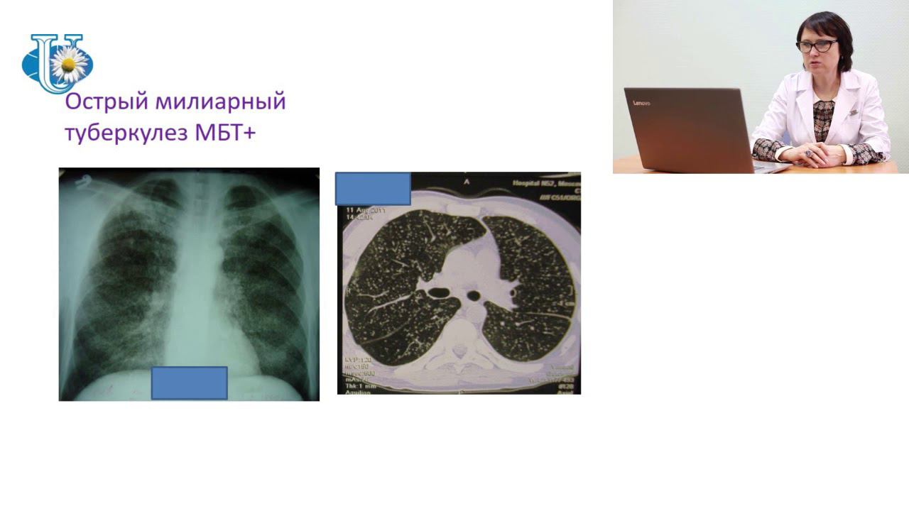 Дифференциальная диагностика диссеминированного туберкулеза